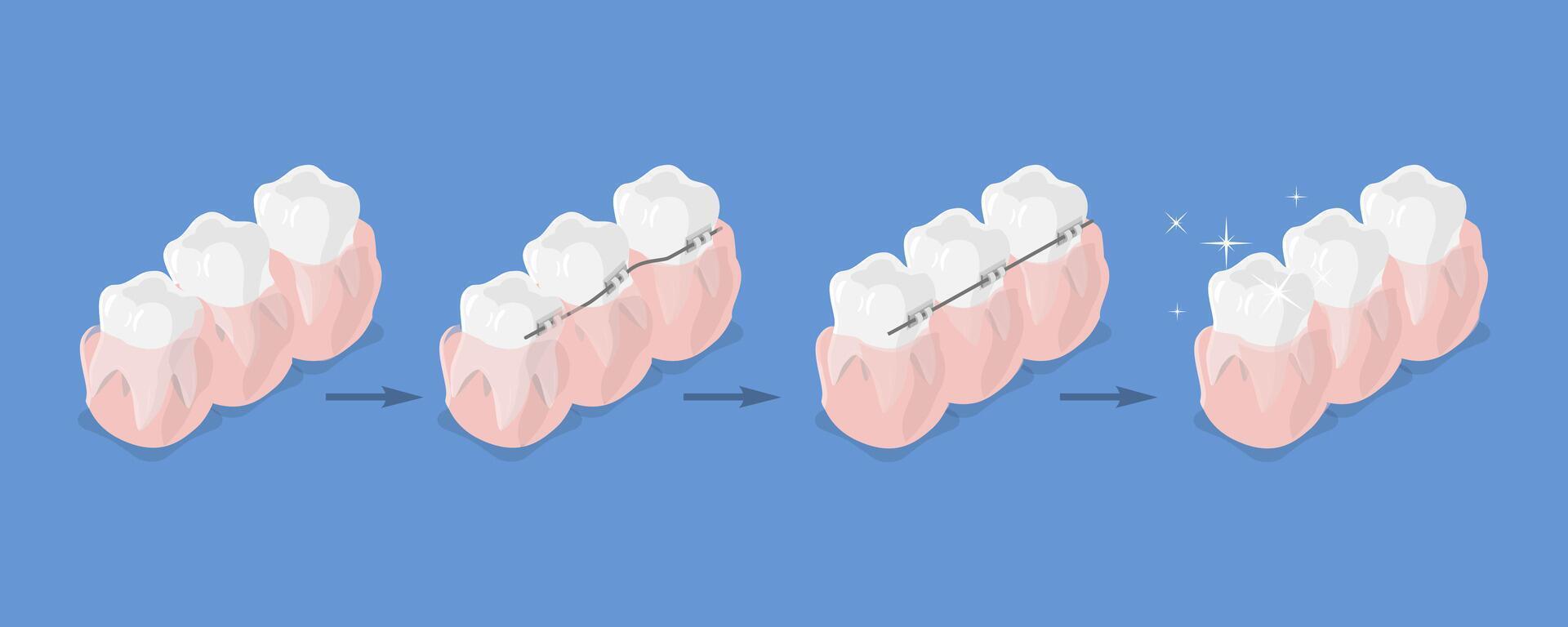 3D Isometric Flat Illustration of Dental Teeth Braces, Orthodontic Care vector