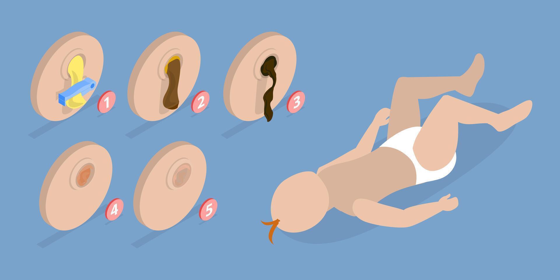 3D Isometric Flat Illustration of Umbilical Cord, After Birth Stages. Swollen, Dry Pus, Scar Tissue, Fall Off vector