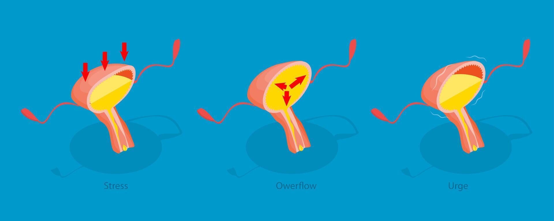 3D Isometric Flat Illustration of Urinary Incontinence, Diagram Outlining Different Types of Incontinence Problems. Stress, Overflow, and Urge vector