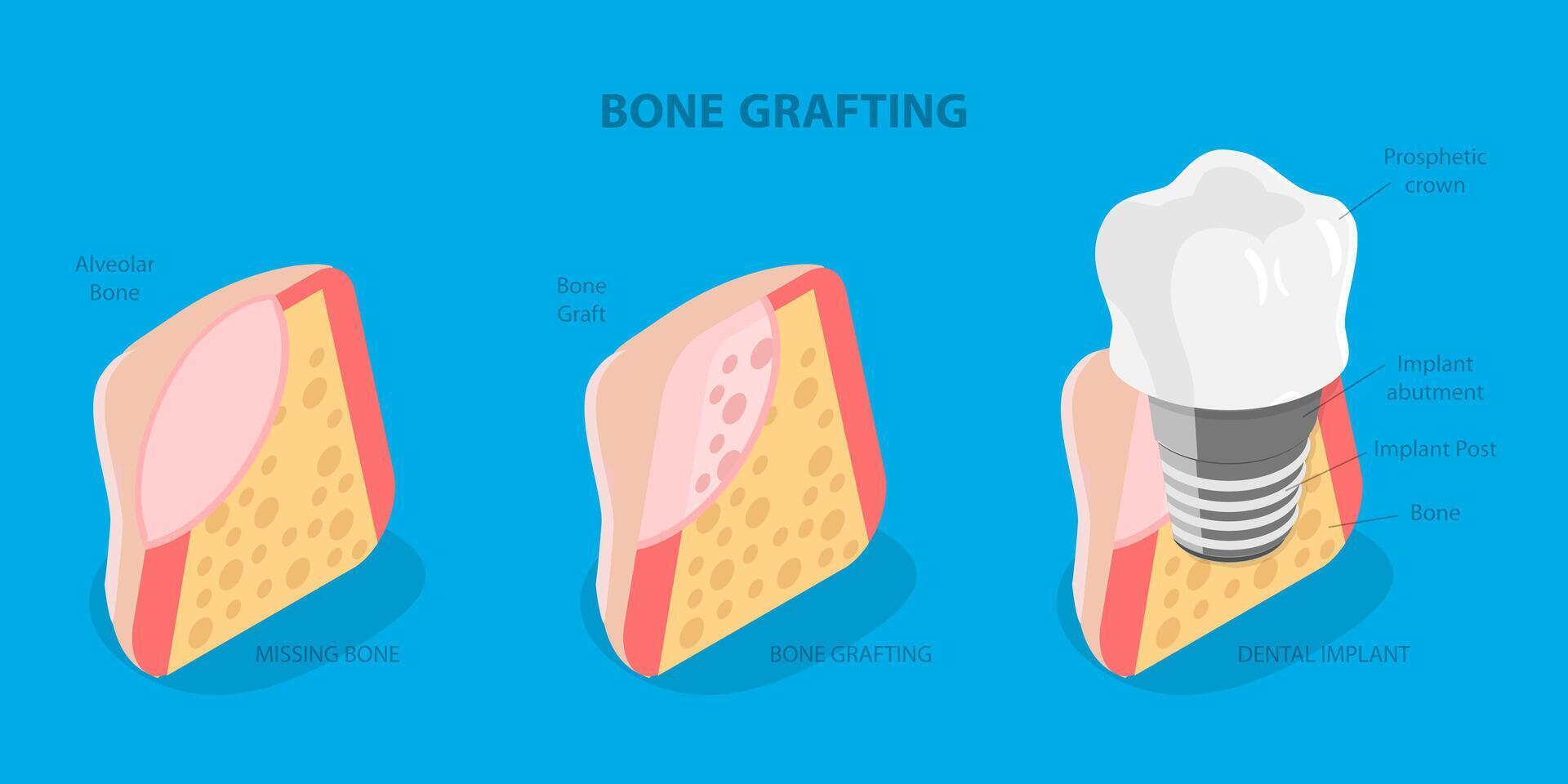 3D Isometric Flat Illustration of Bone Grafting, Understanding of Teeth Structure for Successful Treatment vector