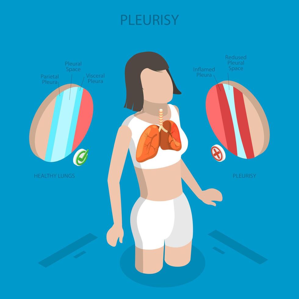 3D Isometric Flat Illustration of Pleurisy Or Pleuritis Disease, Medical Overview of Lung Inflammation vector