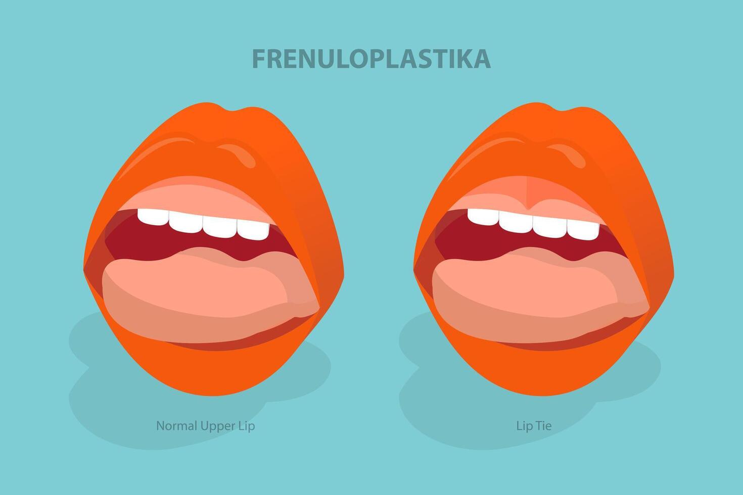 3D Isometric Flat Illustration of Frenuloplastika, Lip Tie Before and After Surgery vector