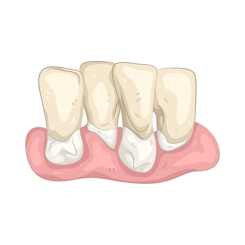 Illustration of perio vector