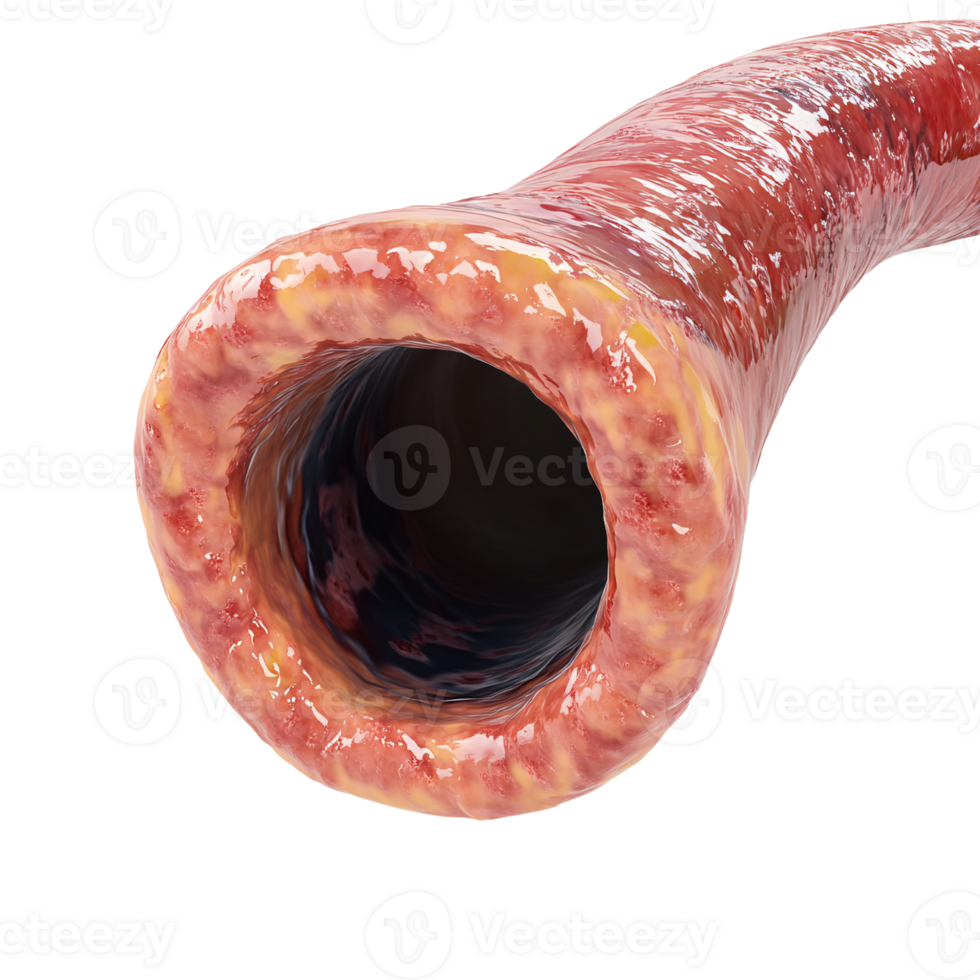Detailed 3D rendering of a human colon with polyps, showcasing colon cancer and digestive health on a transparent background png