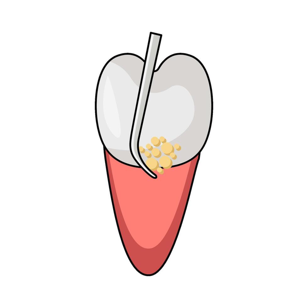 illustration of Root Planing vector