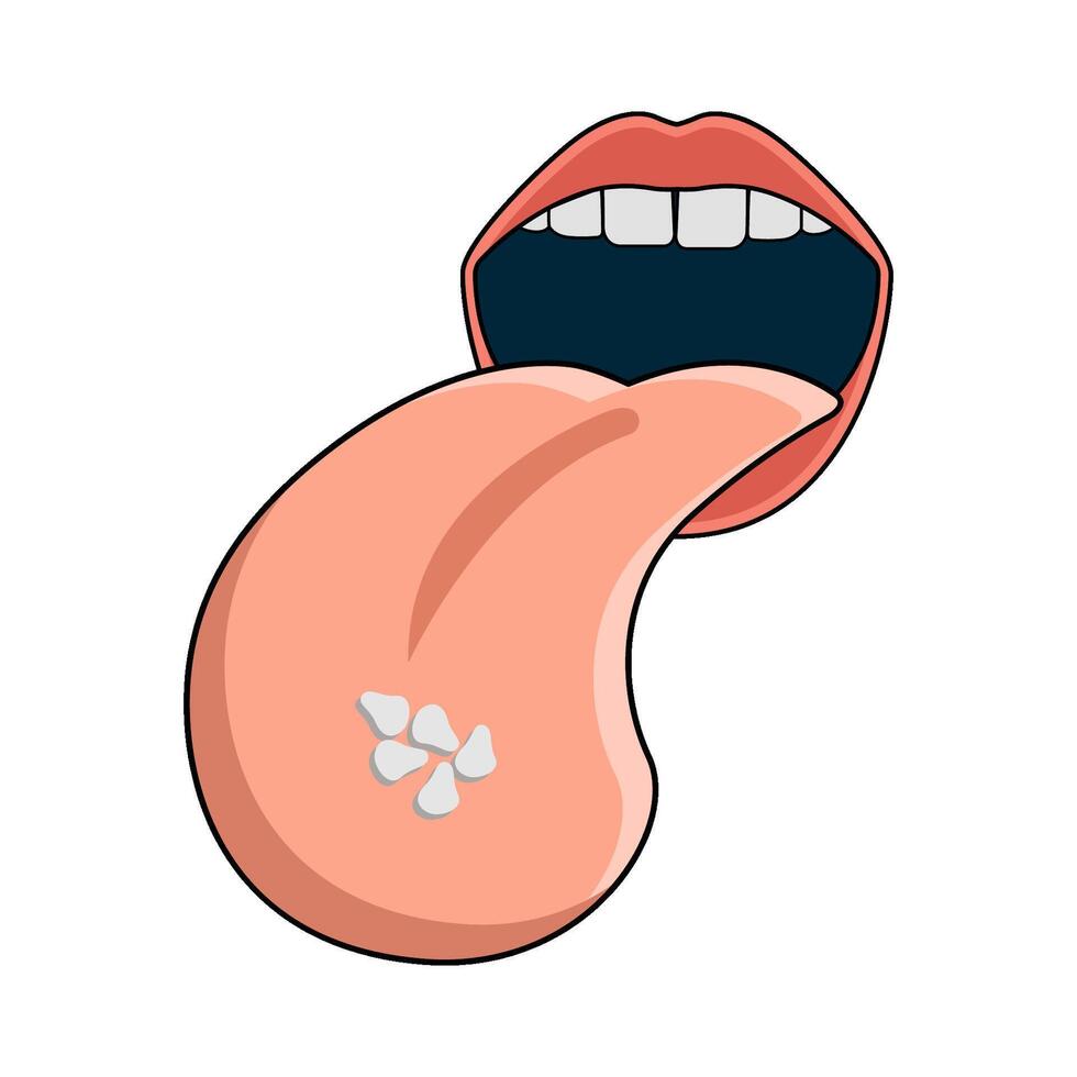 illustration of Dental Thrush vector