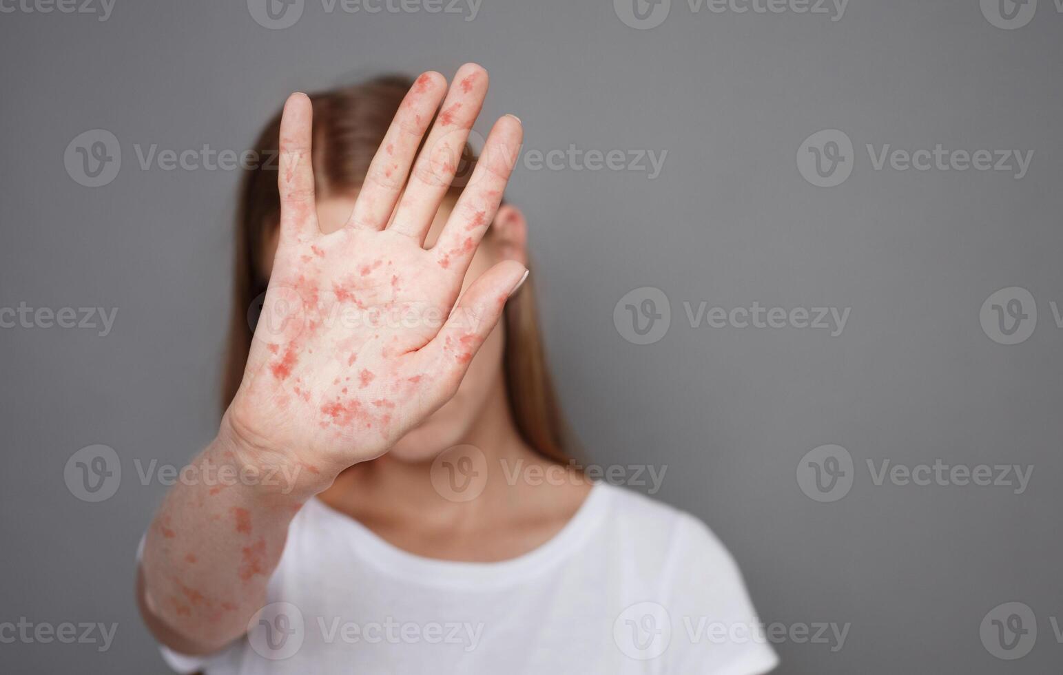 Stop Measles. Girl With Virus Closing Face From Camera Over Grey Background photo