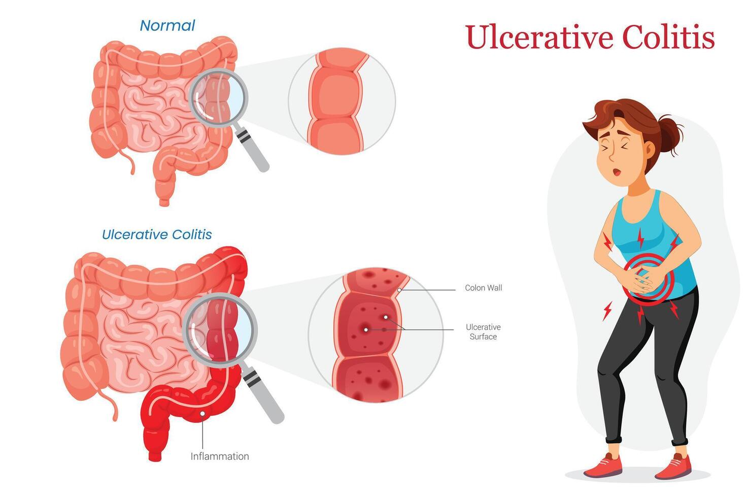 Healthy vs Ulcerative Colitis Intestine Diagram Showing Pain vector