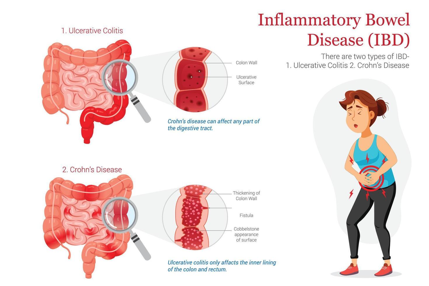 IBD Diagram Comparing Ulcerative Colitis and Crohns Disease with Patient Pain Illustration vector