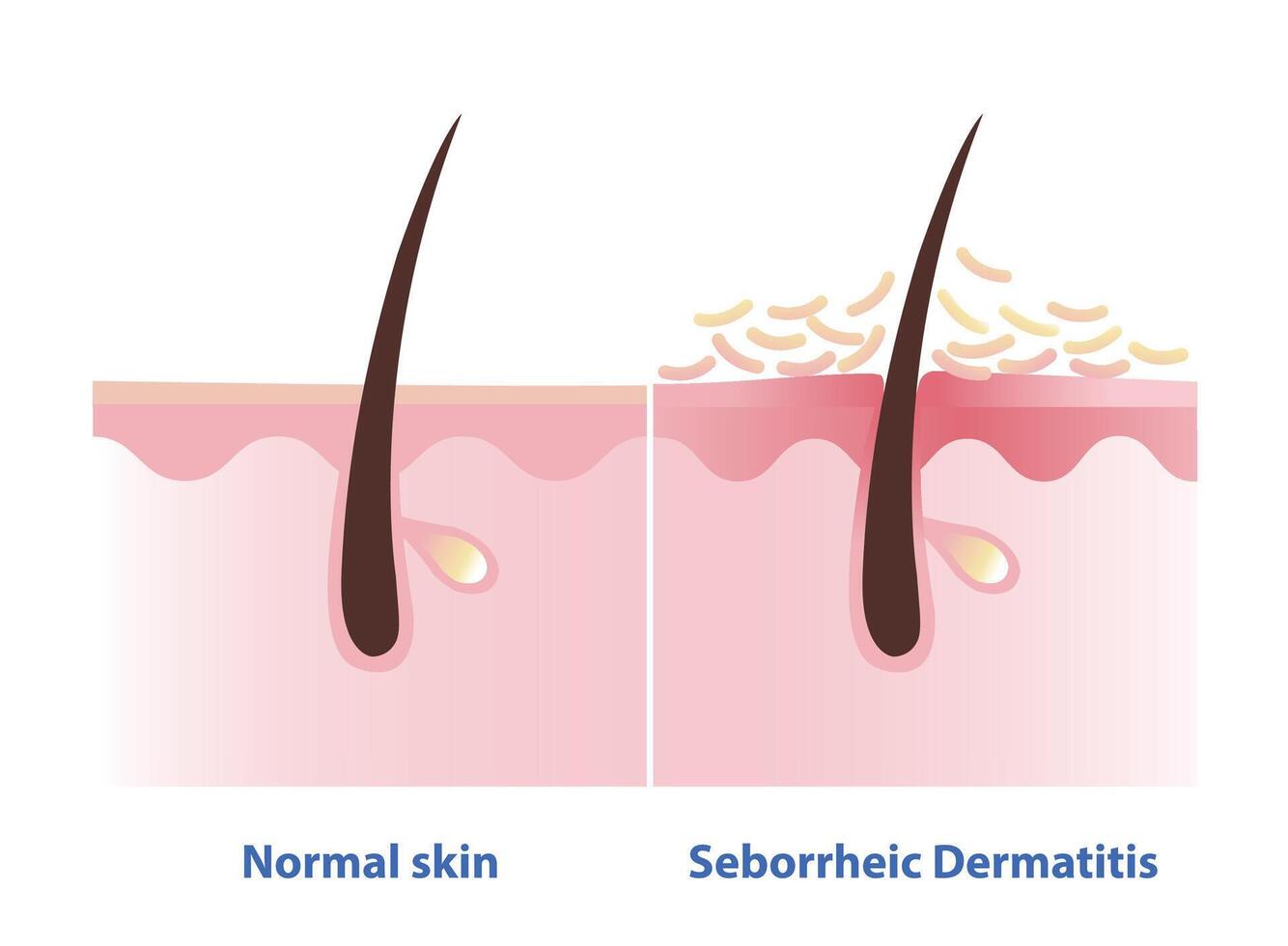 Comparison of normal skin and Seborrheic Dermatitis illustration. Cross section of Sebderm, inflamed, red patches with a greasy scale and flakes over of the skin. Skin care and disorder concept. vector