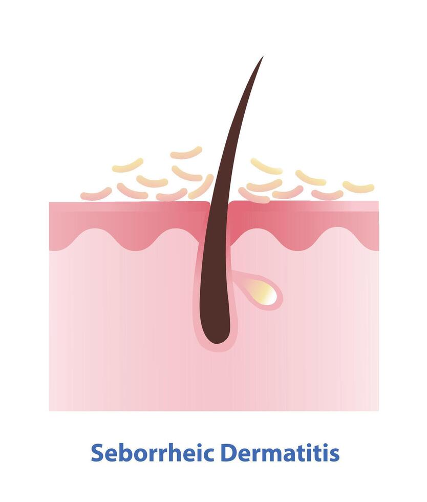 Seborrheic Dermatitis on skin layer illustration. Cross section of Sebderm, inflamed, red patches with a greasy scale and flakes over the oilier areas of the skin. Skin care and beauty concept. vector