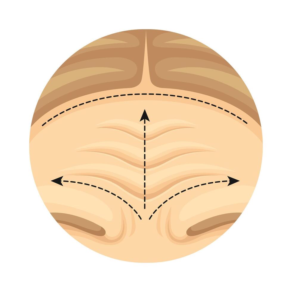 Cosmetic surgery on female forehead with dotted lines. Plastic surgery illustration vector