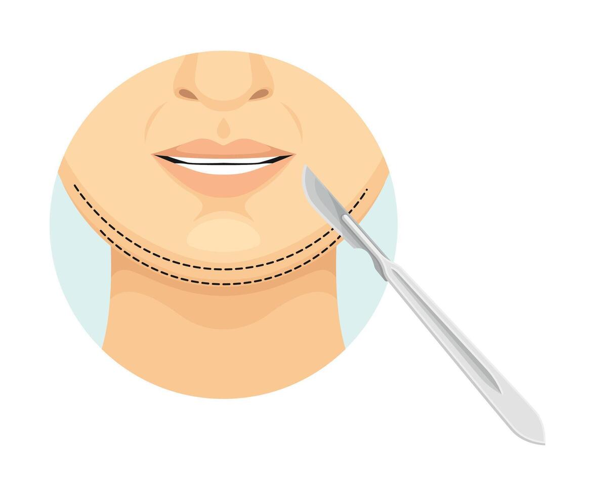 Chin correction procedure, cosmetic surgery on female face with dotted lines. Plastic surgery illustration vector