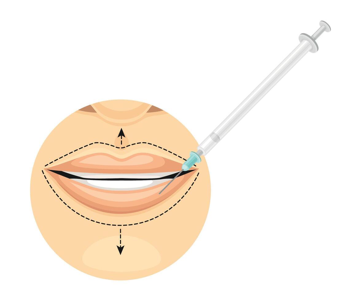 Lip line correction by injections. Cosmetic surgery on female face with dotted lines illustration vector