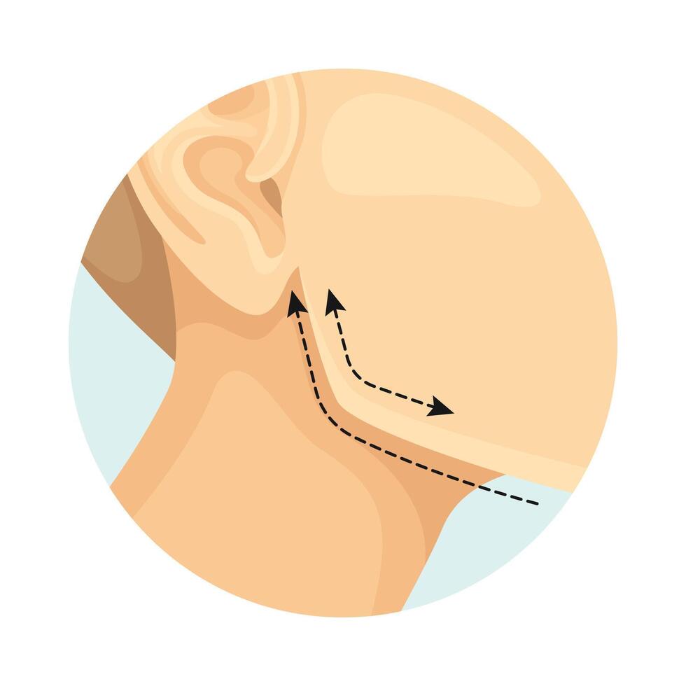 Cheekbone correction cosmetic surgery procedure of female face with dotted lines. Plastic surgery illustration vector