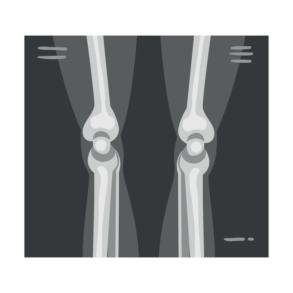 X-ray Film of Leg Joints Illustrated Image for Educational Purpose vector