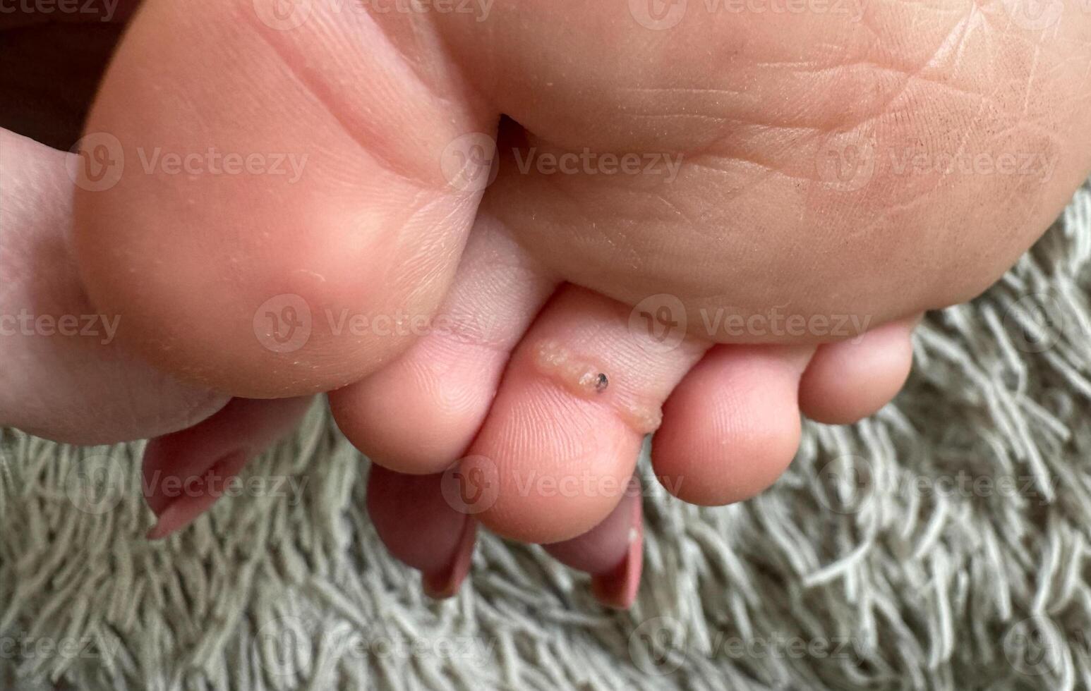 Detailed view of a child's foot featuring a several small wart on one toe. Common skin condition requiring medical attention. photo