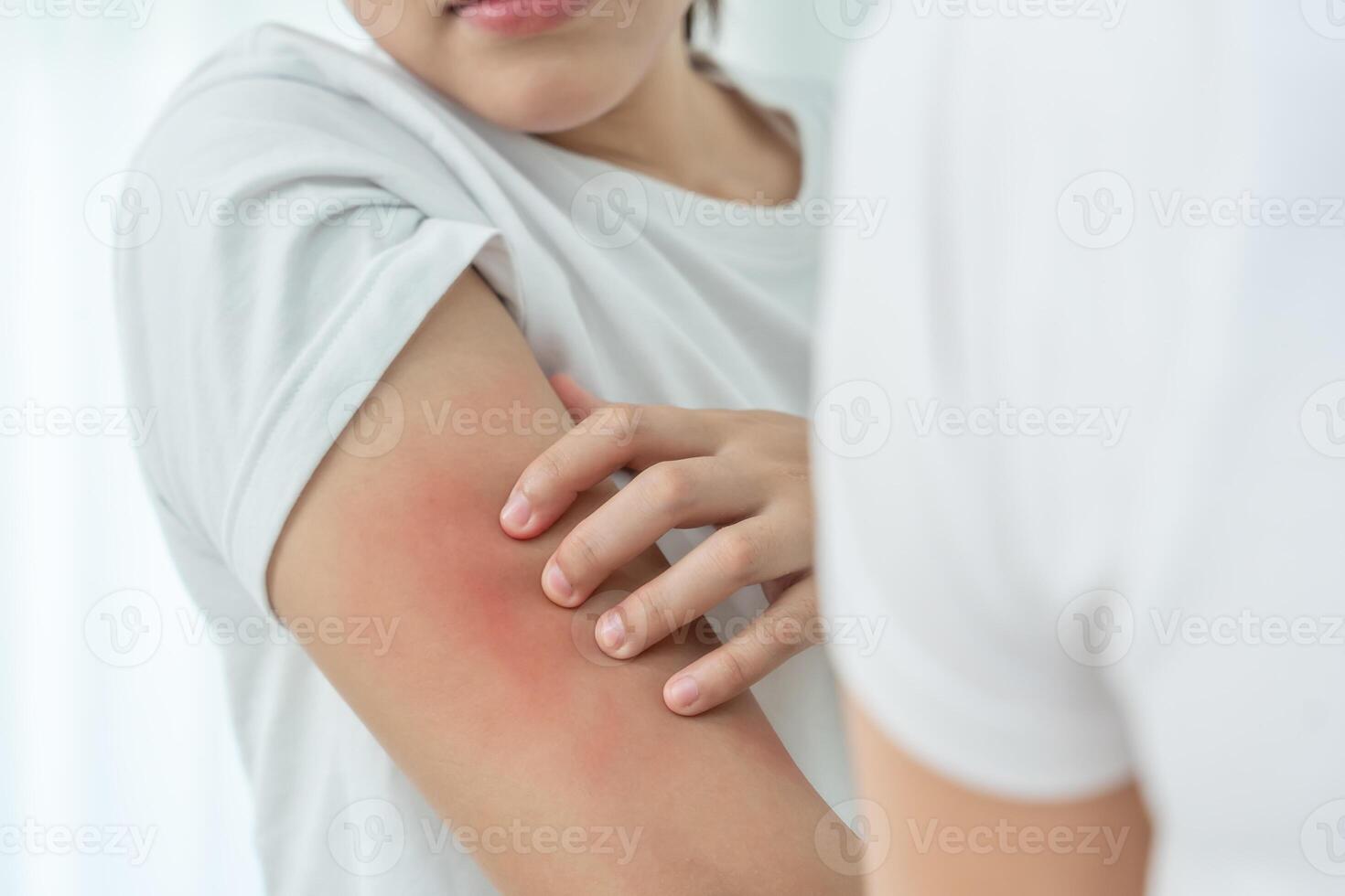 Young woman scratch body has itchy skin from skin allergic, steroid allergy, sensitive skin, red from sunburn, chemical allergy, rash, insect bites. Seborrheic Dermatitis. photo