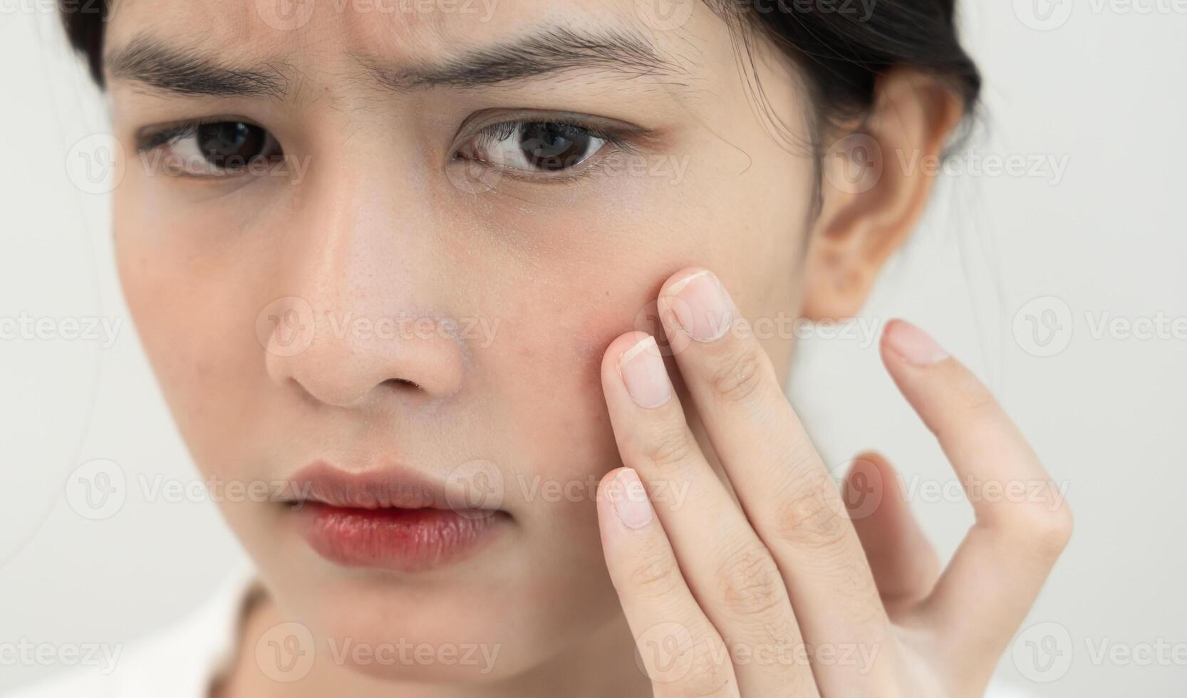 Woman worried about face Dermatology, rosacea dermatitis, allergic steroids, sensitive skin, red face from sunburn, acne, dry skin, large pores ,rash face, dull, freckle, wrinkle, skin problem photo