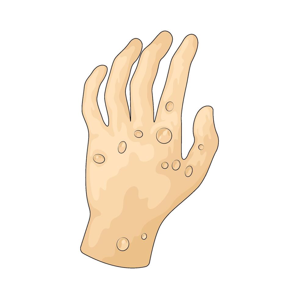 illustration of allergy vector