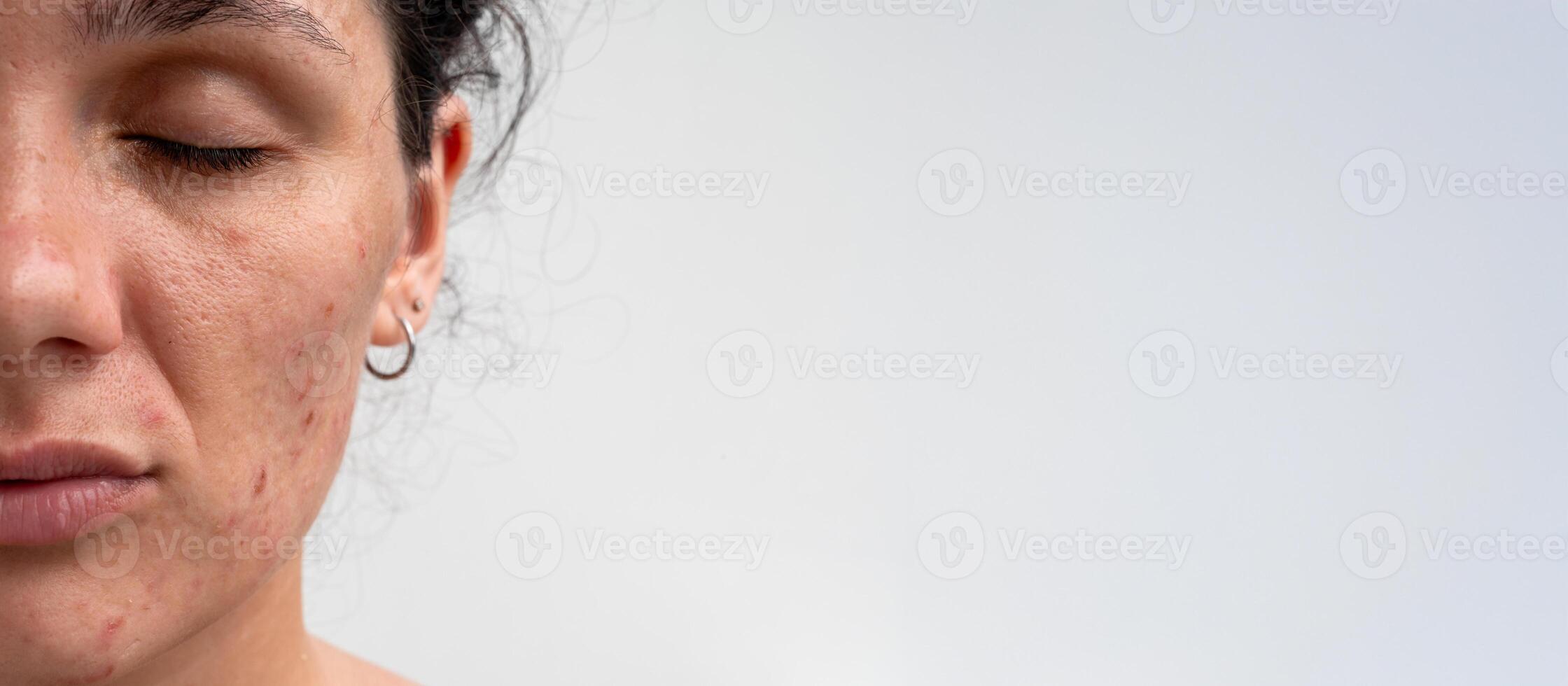 Close-up portrait of a young Caucasian woman with skin problems - pimples, acne, enlarged pores. A place for your text. photo