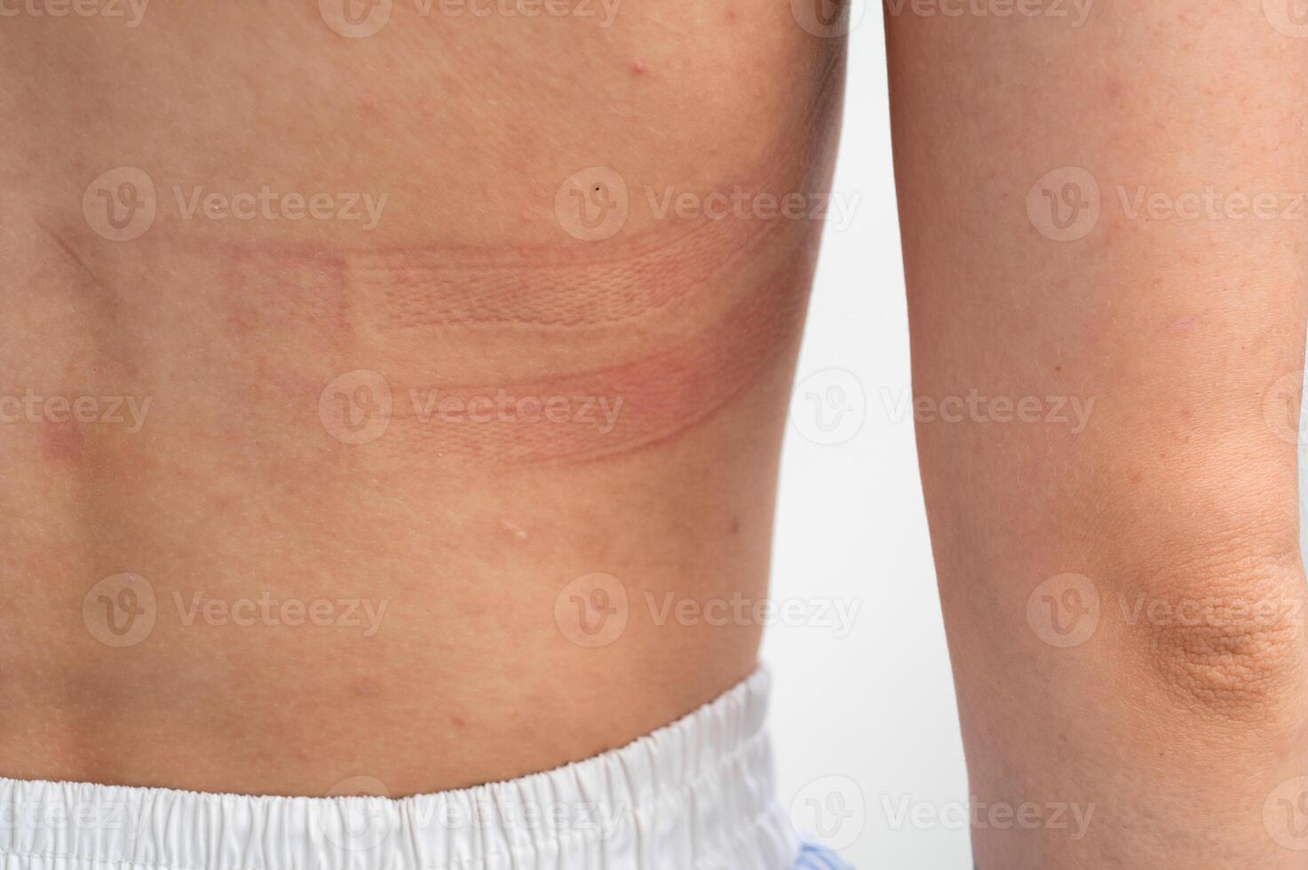 Bra marks on the back. The girl rubbed her back with her underwear. Uncomfortable bra. The wrong size underwear. Traces of clothing on the body. photo