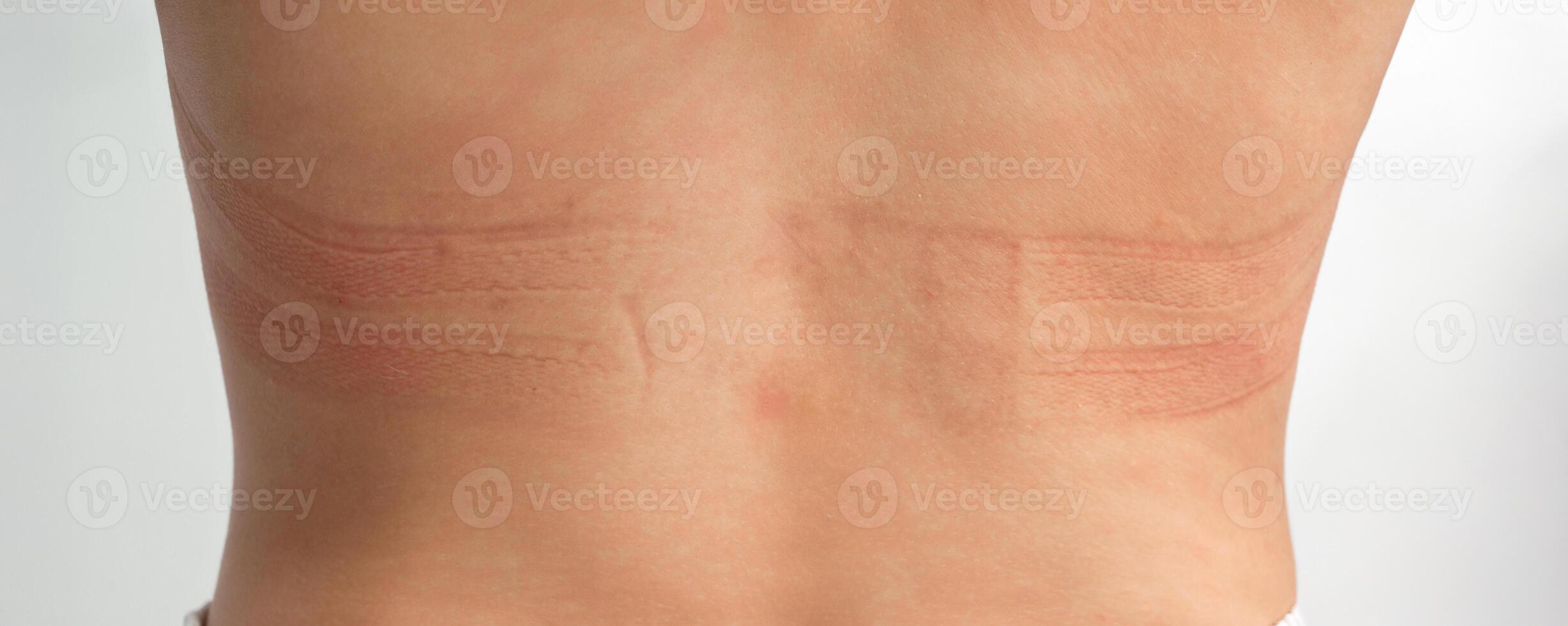 Panoramic view of the bra marks on the back. The girl rubbed her back with her underwear. An uncomfortable bra. The underwear is the wrong size. Traces of clothing on the body. photo