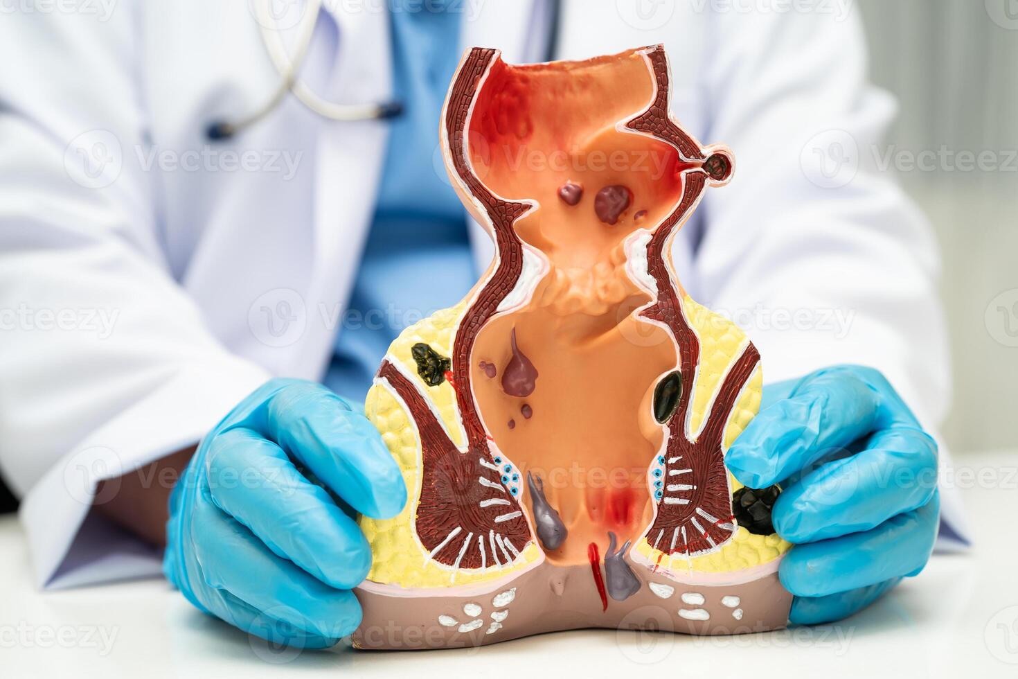 doctor with rectum and hemorrhoid human anatomy model at hospital, inflamed vascular structure. photo