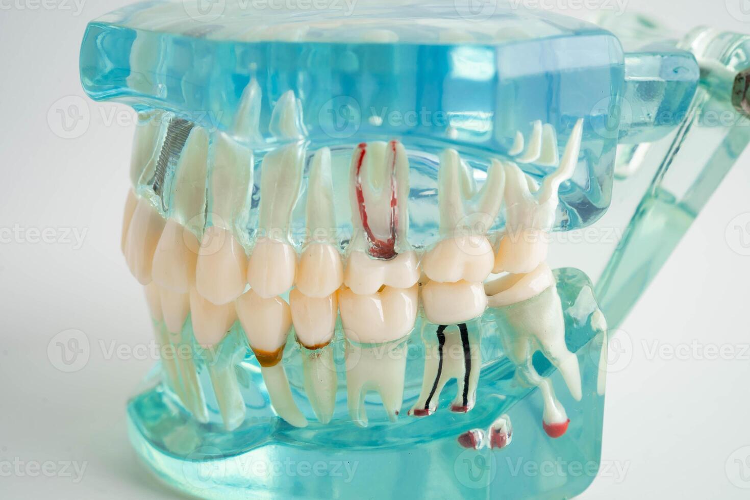 Dental implant artificial tooth roots into jaw, root canal of dental treatment, gum disease photo
