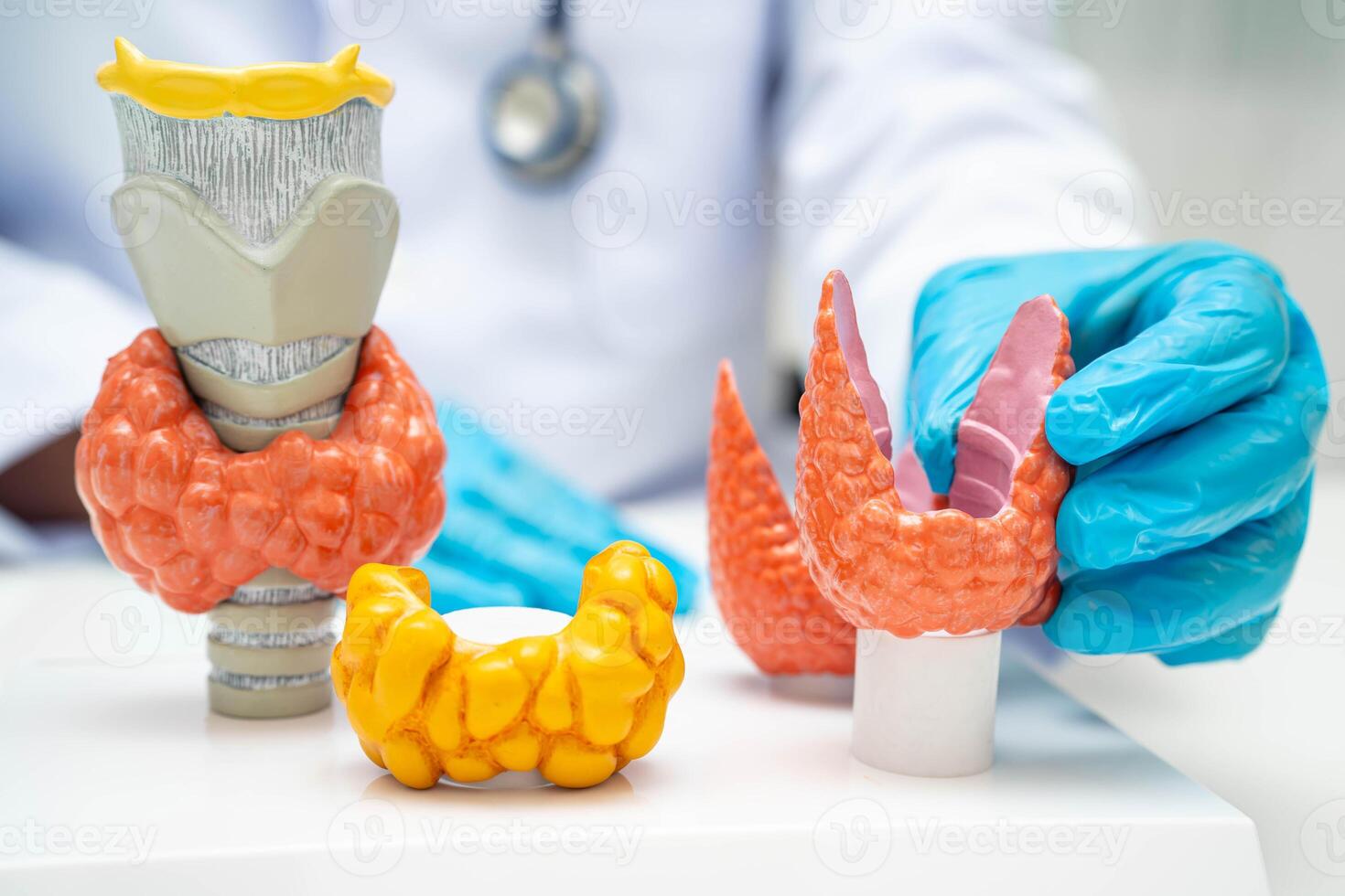 Hyperthyroidism Overactive Thyroid, Thyroid Lymphoma, photo