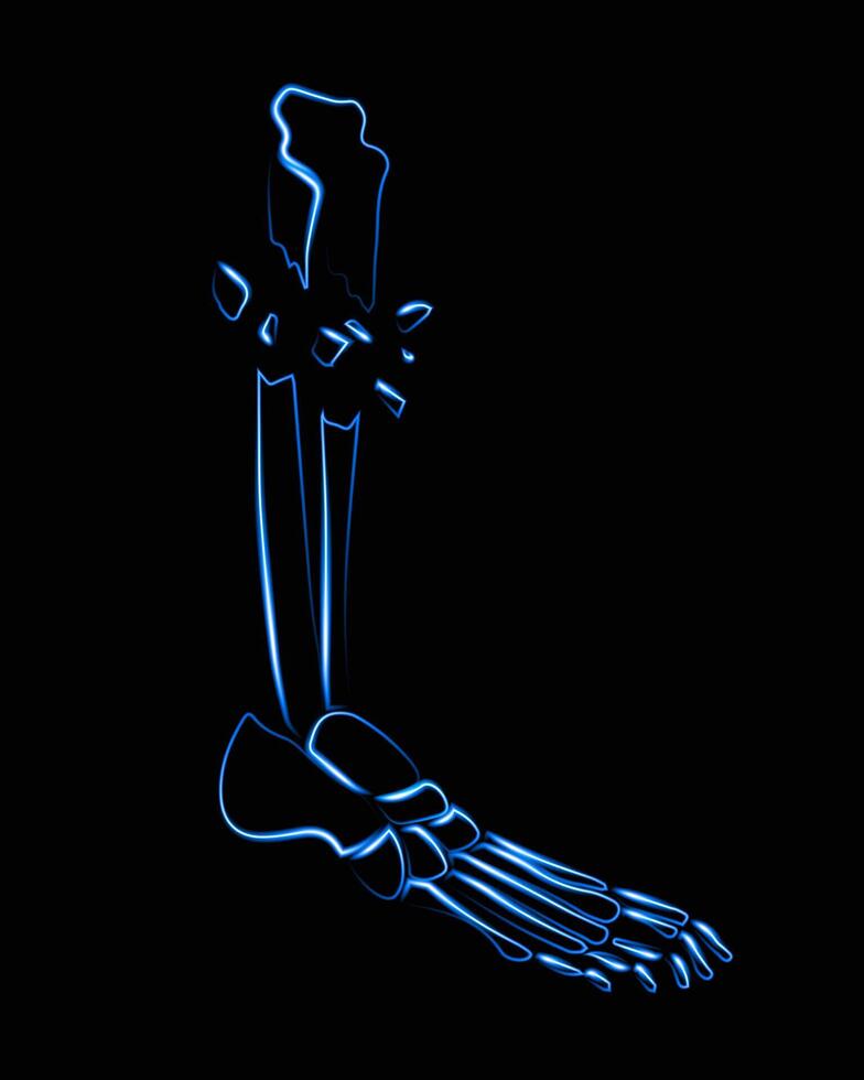 An open fracture of the tibia. X-ray of the leg. vector