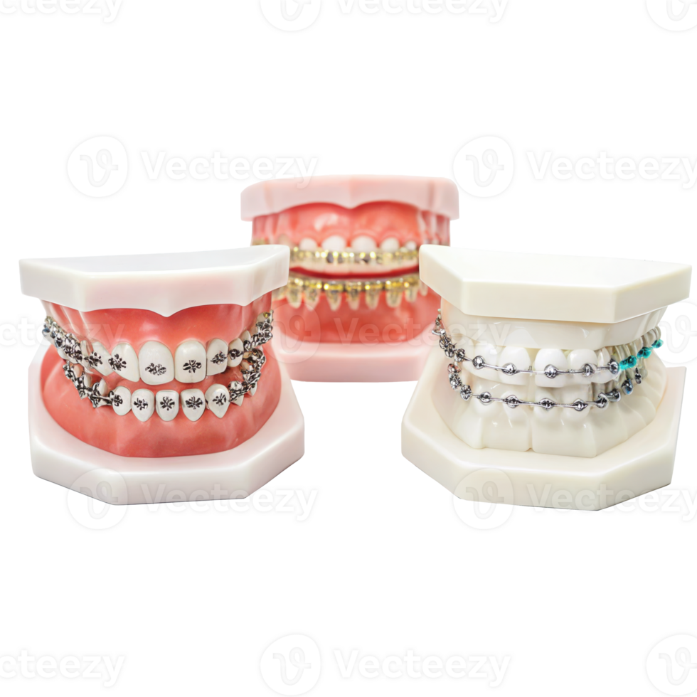 Orthodontic brackets showing different types of braces on transparent background png