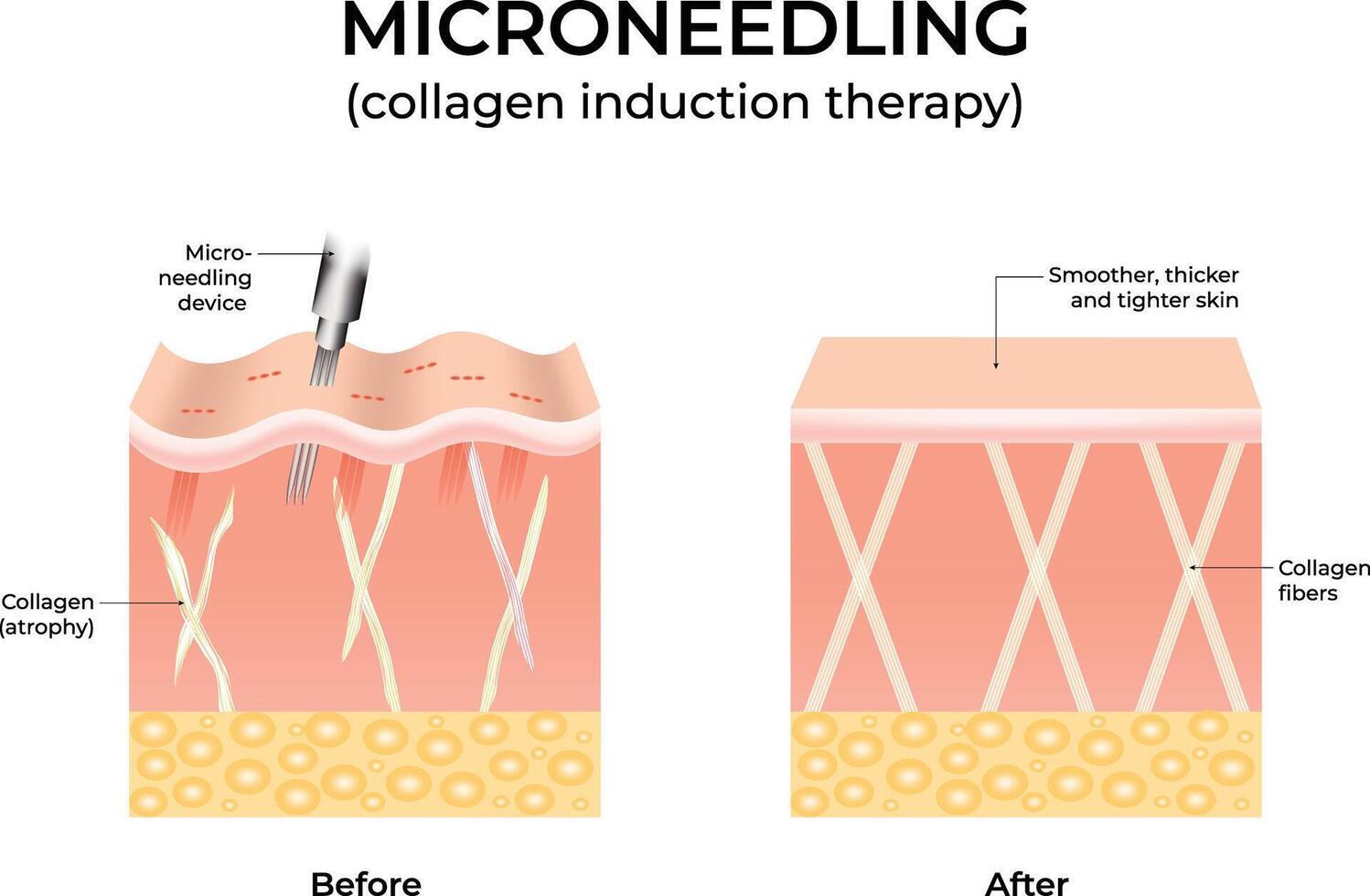 Microneedling Before and After Skin Rejuvenation Design Illustration vector