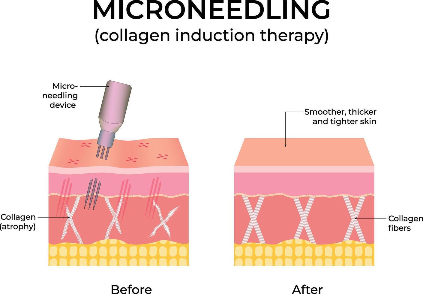 Microneedling Collagen Induction Therapy Diagram Design Illustration vector