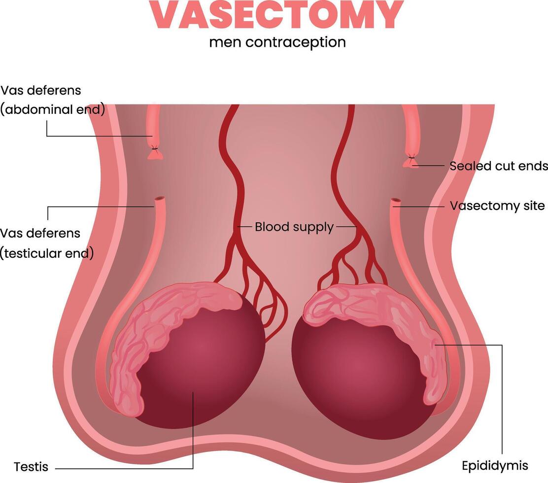 illustration of vasectomy diagram vector