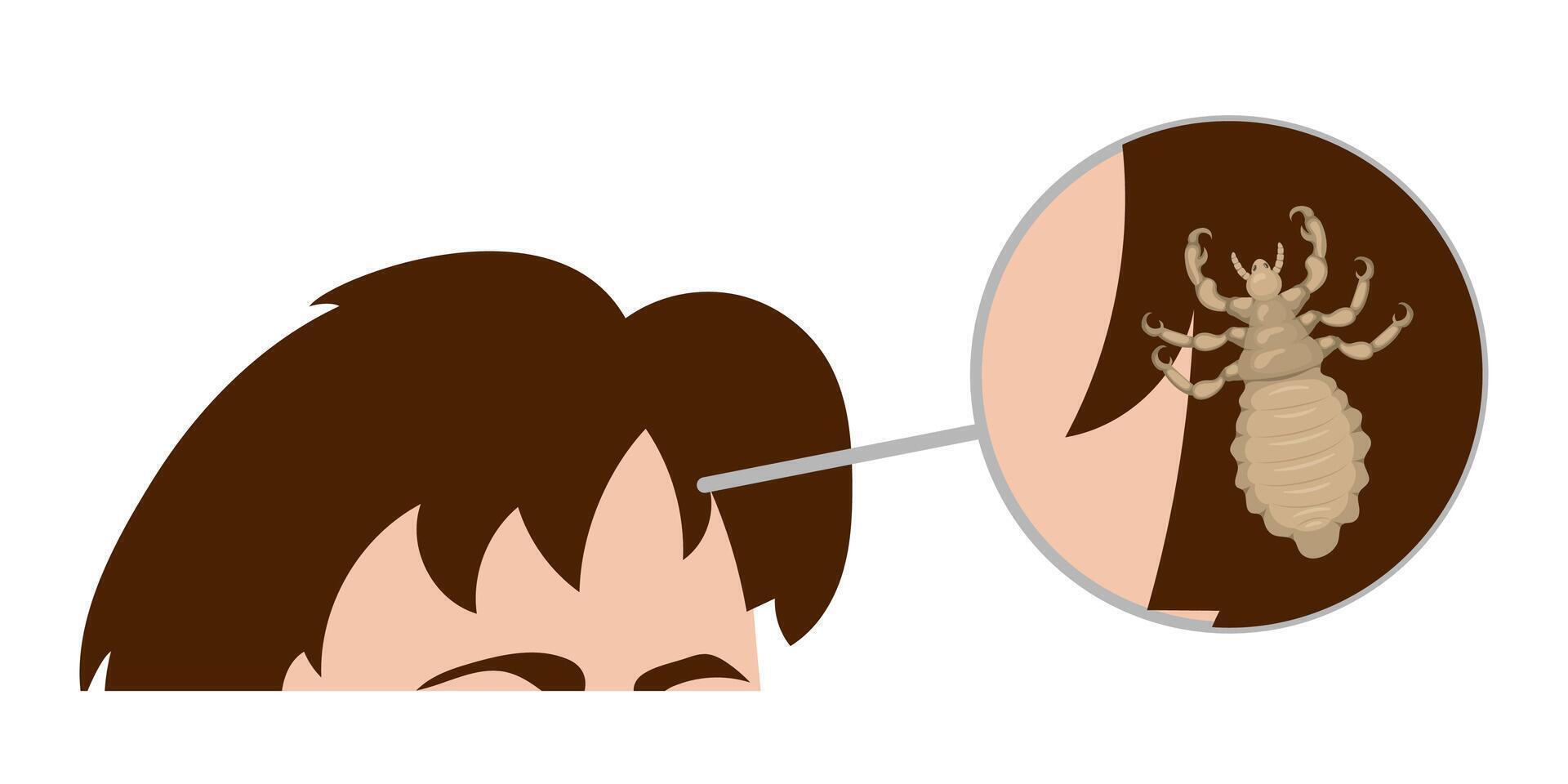 Magnifying glass showing head louse attached to hair on person's head vector