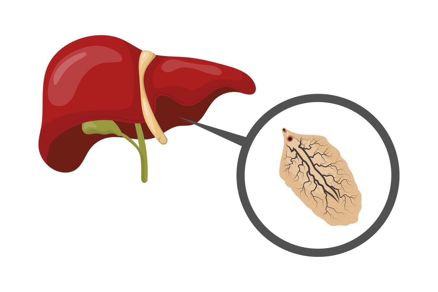 Liver fluke causing fascioliasis, infecting human liver, medical illustration vector