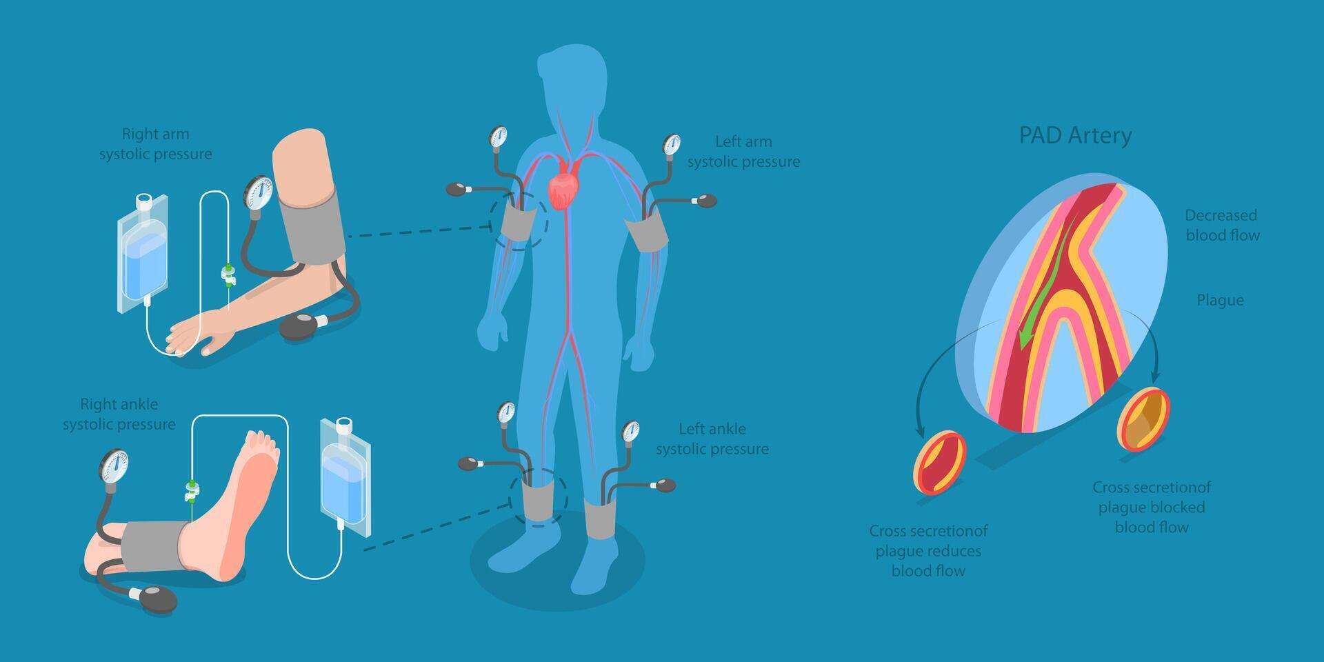 3D Isometric Flat Illustration of ABI Test, Limb Ischemia Diagnosis vector