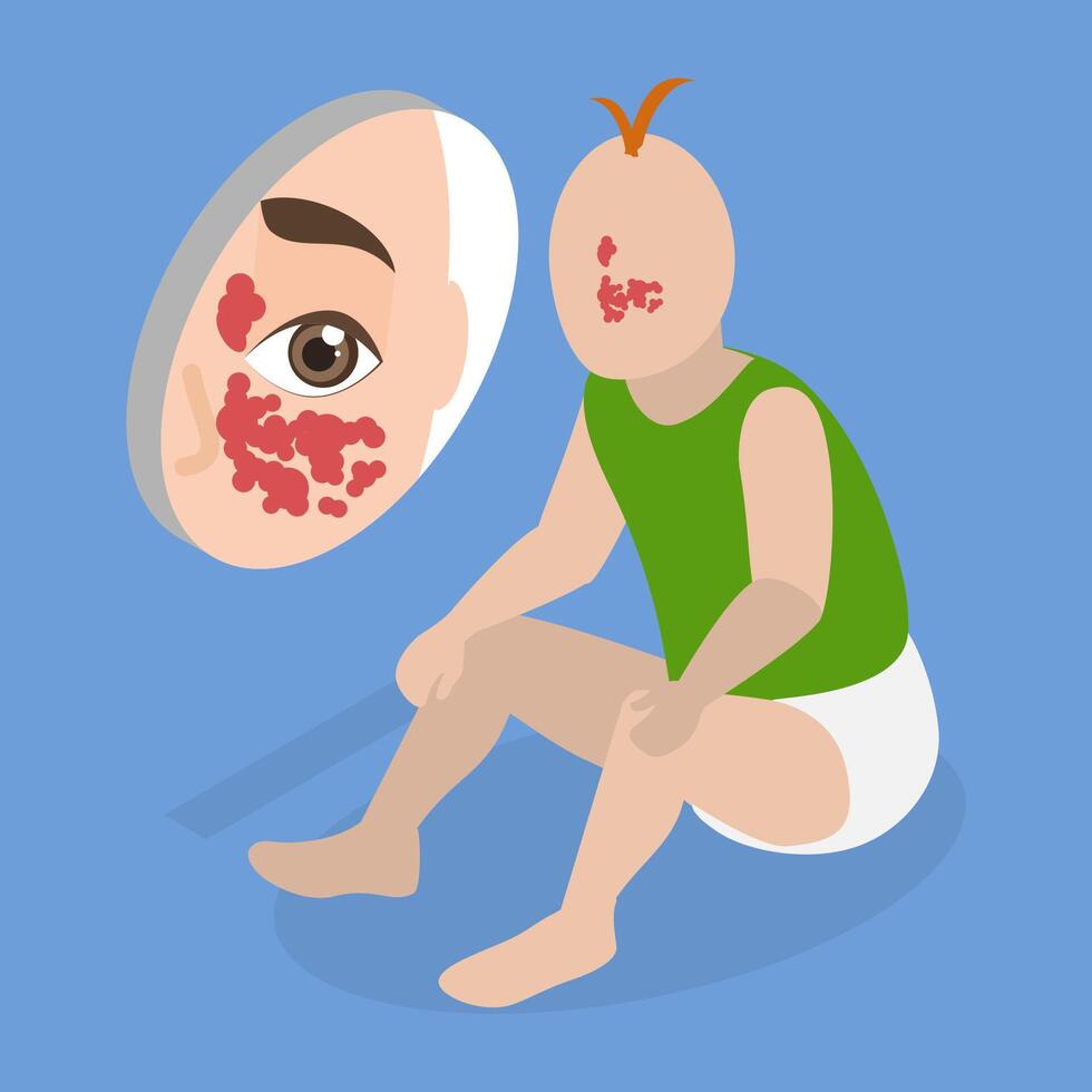 3D Isometric Flat Illustration of Hemangioma, Birthmark Stain on the Face vector