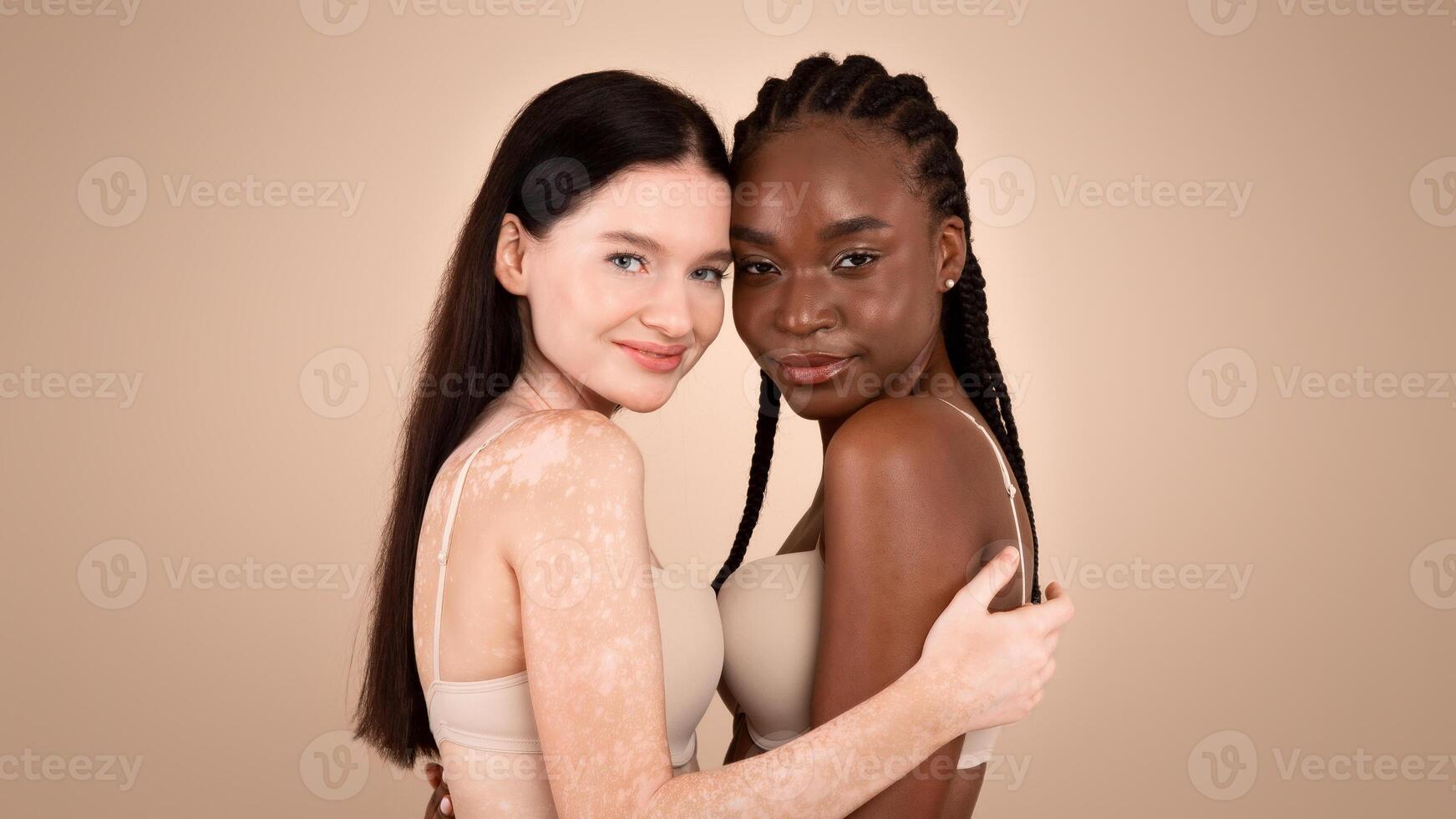 Different Beauty. Young Black Lady And Woman With Vitiligo Disorder Posing Together Over Beige Background In Studio, Body Positive Multiracial Females Wearing Bra's And Smiling At Camera, Copy Space photo