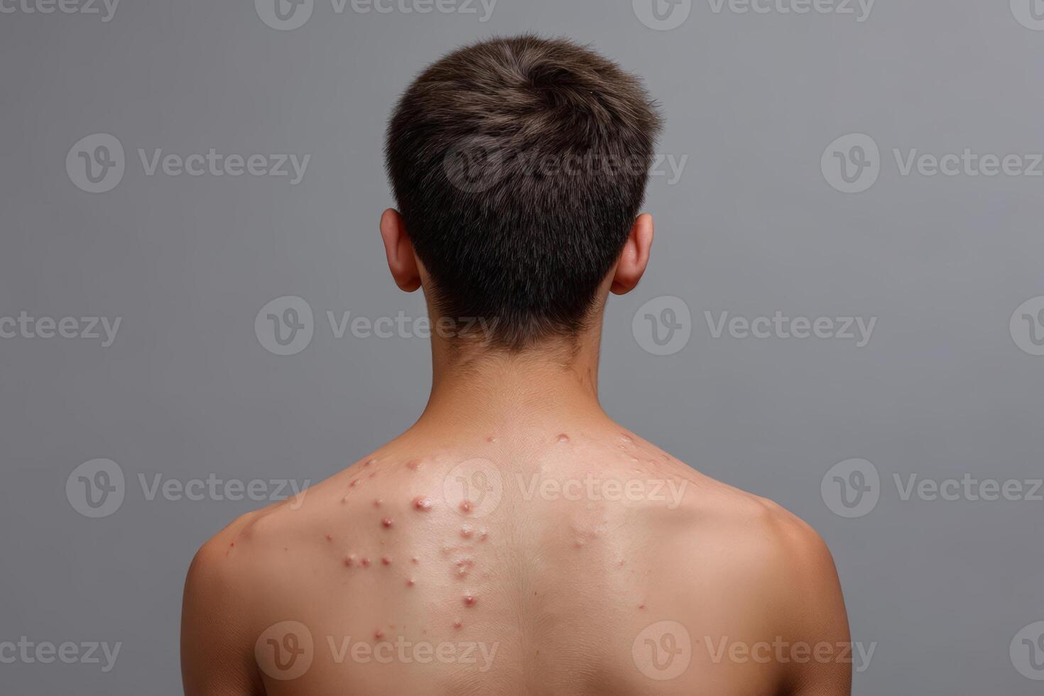 Skin condition effects visible on the back of a young male subject in a neutral setting photo