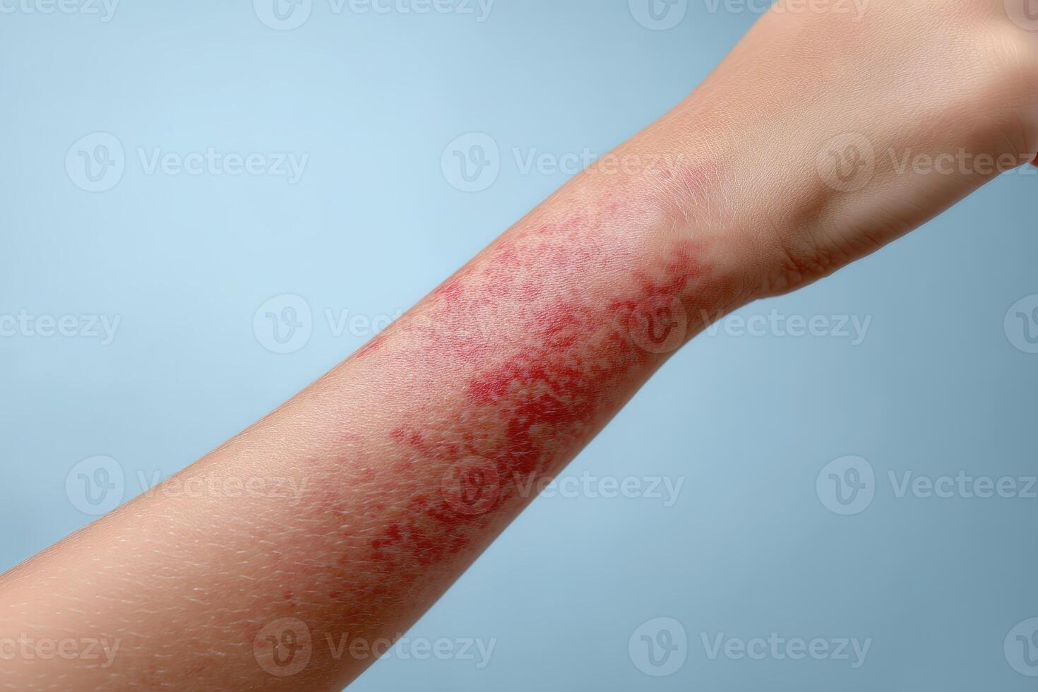 Skin condition displaying redness and irritation on a person's arm against a light background photo