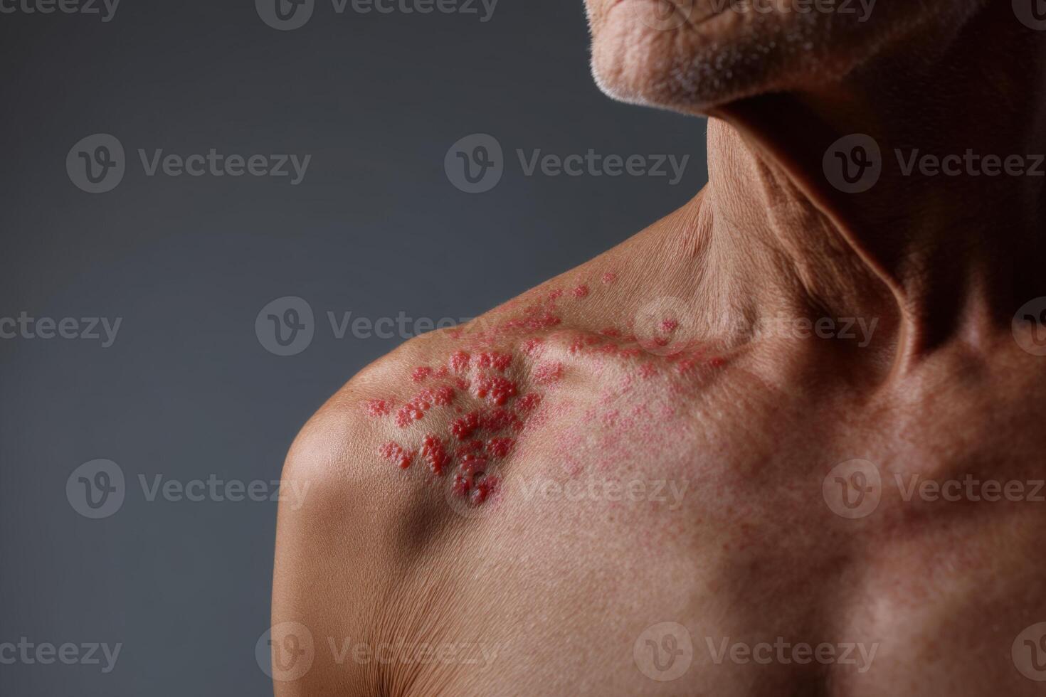 Skin condition affects older man's shoulder with red spots in close-up view during indoor session photo