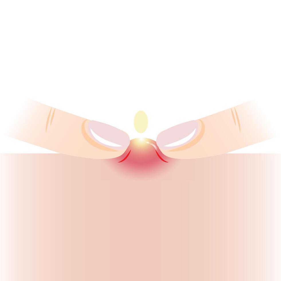 Infographic of squeezing pimple with two fingers on skin illustration isolated on white background. Pustule, inflammatory acne on skin, squeeze, popping pimple. Skin care and beauty concept. vector