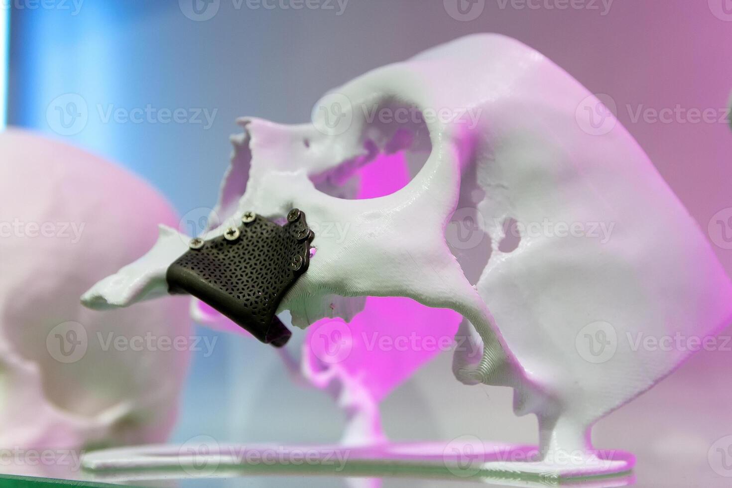 Layout of the human skull with implants made using 3D printing technology. Medicine photo