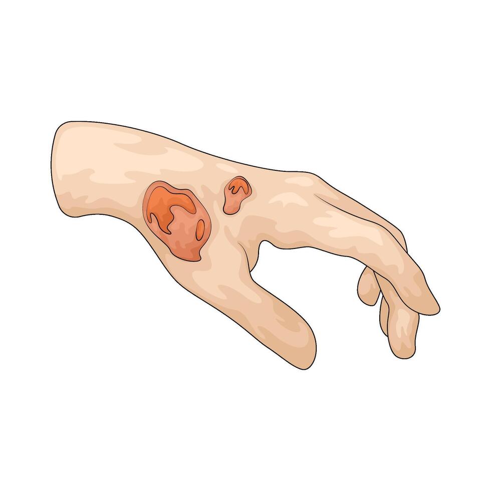 wound on hand vector