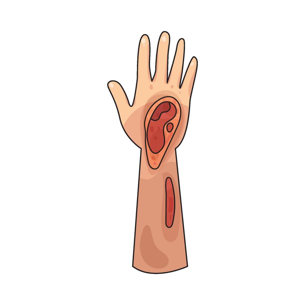 Illustration of wound hand vector