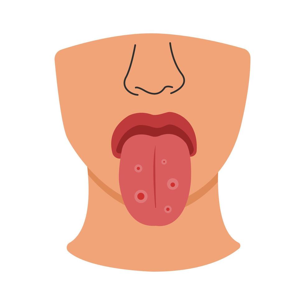 syphilis symptoms. syphilis on tongue disease concept vector