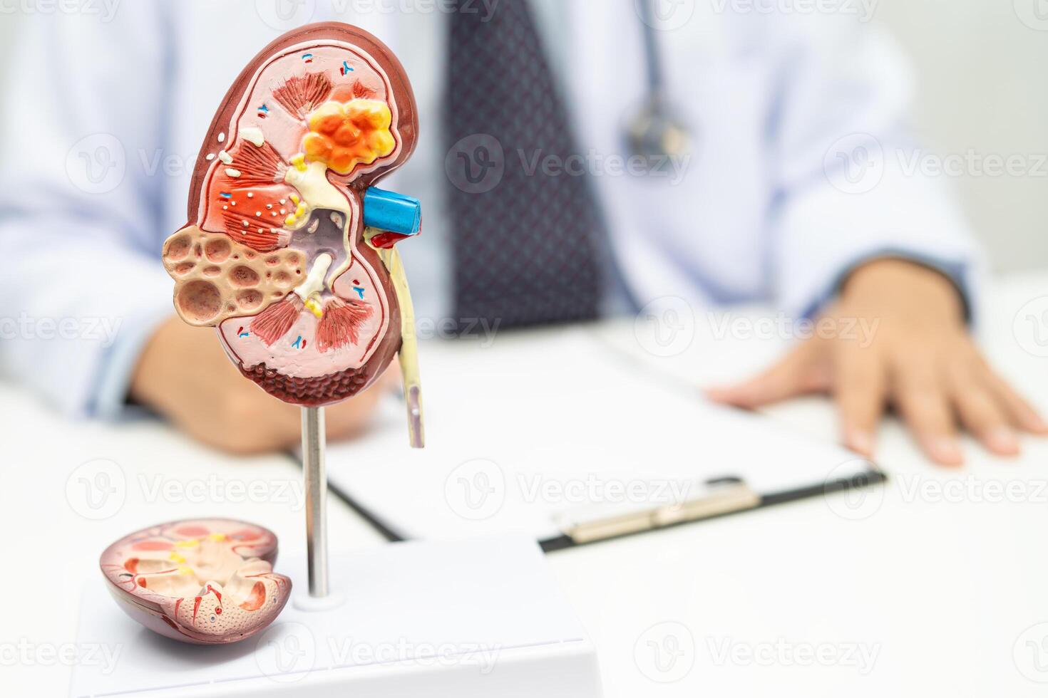 Chronic kidney disease ckd, Doctor hold human model to treat and study in hospital. photo