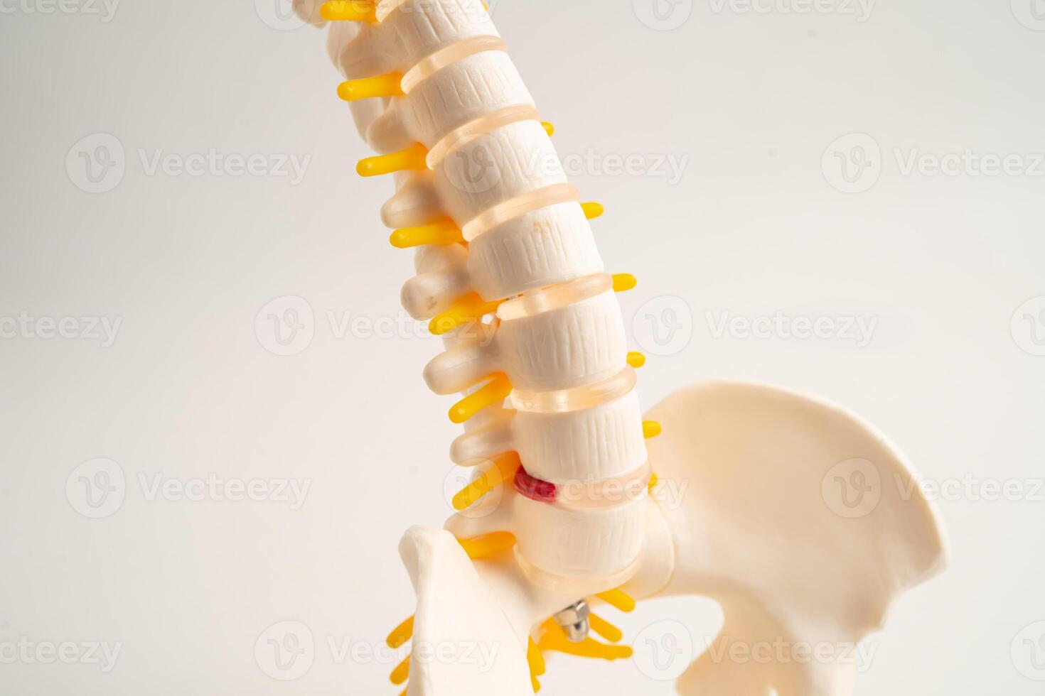 Lumbar spine displaced herniated disc fragment, spinal nerve and bone. Model for treatment medical in the orthopedic photo